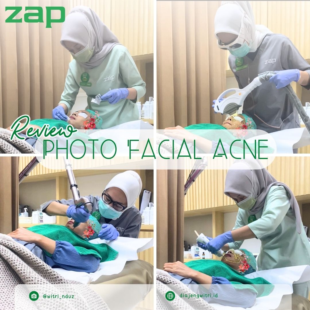 Review Photo Facial Acne di ZAP Setiabudi Semarang